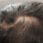 Treatment for Hair & Scalp Loss Problem